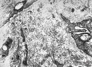 M,9y. | IgA nephropathy